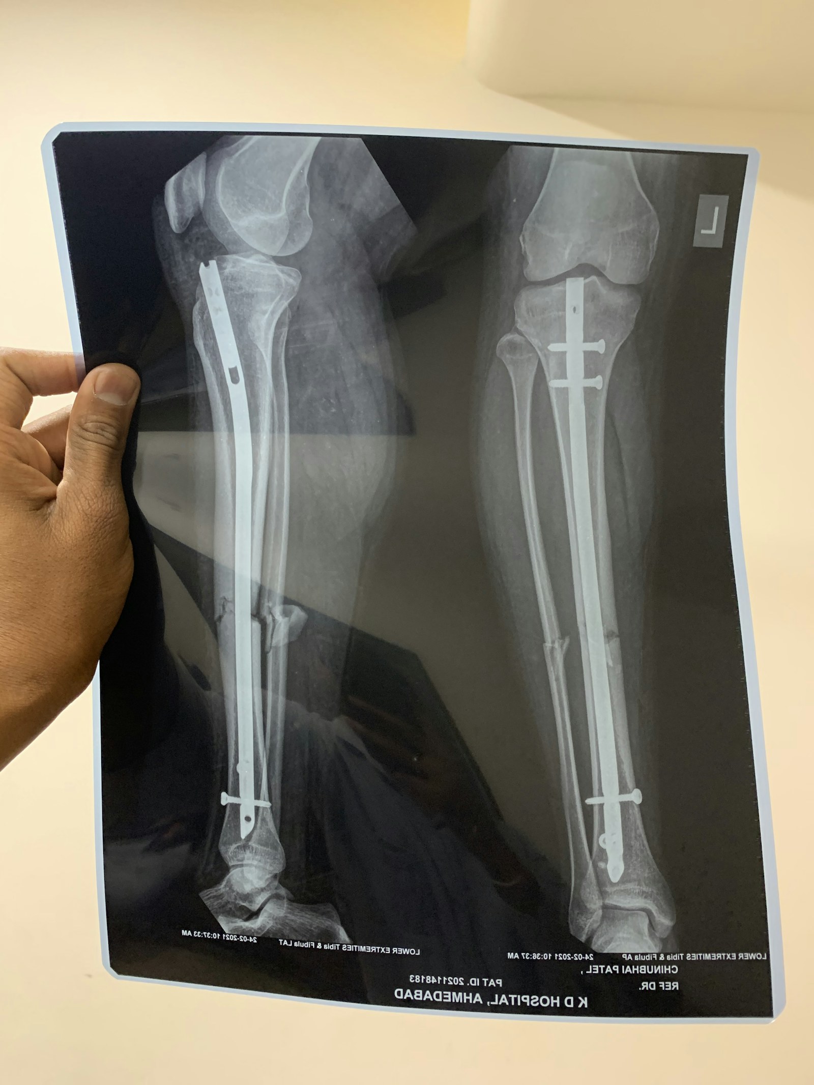 Clinician reviewing an orthopedic X-ray of a knee implant